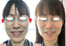 頬と目の間のシワの原因は乾燥ではなく”顔の使い方”だった！ | 美容整形不要！シワとたるみを改善できる顔体操教室