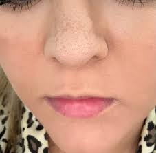 What's causing my nose skin issue?