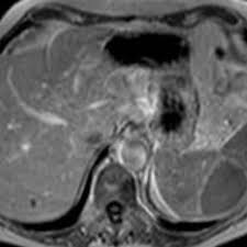 Image result for Splenic Abscess
