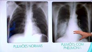 Pneumonia este o infectie pulmonara obisnuita in care saculetii pneumatici ai plamanilor devin inflamati. Bem Estar Pneumonia Pode Ser Identificada Atraves De Um Raio X Globoplay