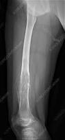 Image result for Osteosarcoma