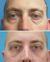 Eyelid Surgery Chicago