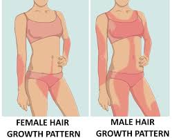 Male pattern baldness (androgenetic alopecia). A Guide To Excess Hair Growth In Women