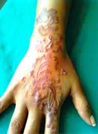 Check spelling or type a new query. Delayed Type Hypersensitivity To Henna Tattoo Components 2 Case Reports