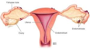 Cara menyembuhkan penebalan dinding rahim secara total. Rose V Nasa Endometriosis Endometriosis Adalah Suatu Penyakit Pada Sistem Reproduksi Wanita Di Mana Jaringan Dari Lapisan Dalam Dinding Rahim Atau Endometrium Tumbuh Di Luar Rongga Rahim Tiap Bulan Tubuh Wanita Akan