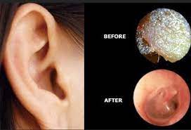 Home Remedies For Ear Wax Removal Nutriclue Tinnitus Remedies Natural Remedies Ear Wax Removal