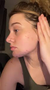 Hi! I'm new to this group. I wish to learn more about managing my skin