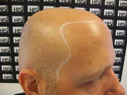 Now order online, watch the video and get great looking hair. The Stories Behind The Craziest Inventions Men Have Used To Color In Their Bald Spots