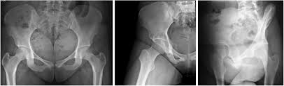 Image result for Hip XRay