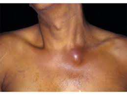 Image result for Septic Joint