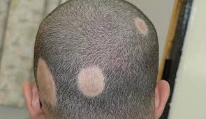 The skin diseases of scalp can lead to hair loss due to excessive itching or excessive acrid discharges from the lesions. Alopecia Areata Homeopathy Treatment Lucknow Delhi Mumbai India Expert Cancer Homoeo Clinic