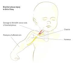 Check spelling or type a new query. Erb S Palsy