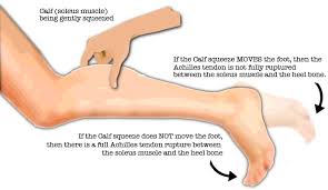Achilles Tendon Rupture Recovery Time Surgery Exercises Your Health Guideline Achilles Tendonitis Achilles Tendon Ruptures Achilles