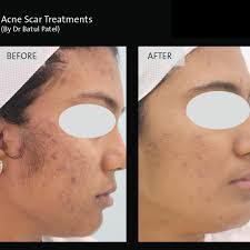 Acne Treatments at Acne Freedom Clinic Mumbai