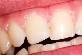 Aici cand va plictisiti vezi afla ce puteti face. Durerea DupÄƒ ObturaÈ›ie