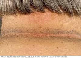 Maybe you would like to learn more about one of these? Acanthosis Nigricans Symptoms And Causes Mayo Clinic