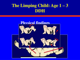 Image result for Pediatric Limp