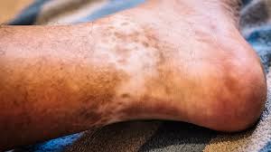 Image result for Lipodermatosclerosis