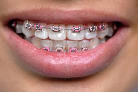 Where you live in your country will cause a difference in pricing as well. Asian Teens Shell Out Money For Fake Fashion Braces Metal Mouth Is Style Trend In Thailand Indonesia And Malaysia Braces Colors Pink Braces Cute Braces Colors