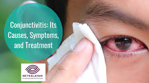 Image result for Conjunctivitis