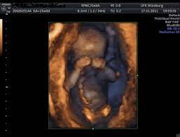 Dieser ultraschall empfälen wir ab der 26. Dein Baby In 3d Was Bietet Ein 3d Ultraschall Und Wann Ist Er Erlaubt Netmoms De