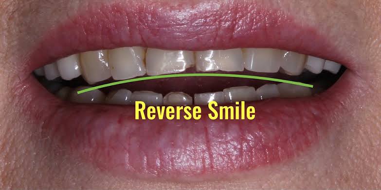 Do You Have a Reverse Smile? - Navarro Dental Group