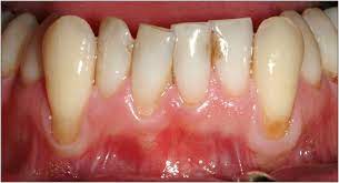 6 Things That White Gums Are Warning You About Your Oral Health C R Dental Group