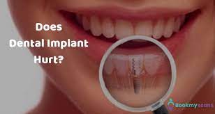 Don't expect them to last a lot longer, however, as that is about the time they are due for replacement. Does Dental Implant Hurt