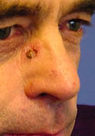 Skin cancer is the most common form of cancer. Hautkrebs Basaliom Tumor