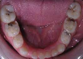 We did not find results for: Beneficios Del Uso De Fluoruro De Estano Blog De Odontologia