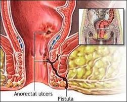 Infection or inflammation can also cause a fistula to form. Ayurvedic Treatment For Fistula In Ano Fistula Treatment In Ayurveda