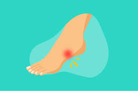 Tulang kaki nyeri saat malam. Ini 4 Cara Atasi Sakit Akibat Plantar Fasciitis