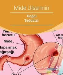 Mide Ulserinin Dogal Tedavisi Gastrik Ulser Ya Da Bilinen Adiyla Mide Ulseri Midenin Mukoza Dokusunda Meydana Gelen Yaralara Ver Health Health Care Disease