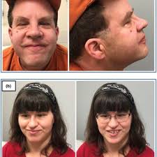 PDF) Community-based recruitment and exome sequencing indicates high  diagnostic yield in adults with intellectual disability