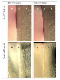 Aug 22, 2013 · relyx™ fiber post technique guide (pdf, 465.8kb) 3m™ relyx™ fiber post cementing endodontic post (pdf, 935.0kb) cementation guide for glass ceramics made with chairside cad/cam systems (pdf, 847.5kb) Effect Of Cementation Technique Of Individually Formed Fiber Reinforced Composite Post On Bond Strength And Microleakage