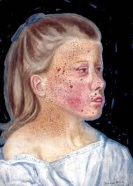 Herpétide vesiculosa: eczema agudo herpético” Pintat i cromolitografiat per  Acevedo, litografiat per Mateu i publicat per