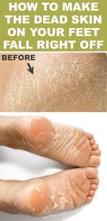 You can then scrub your feet gently to get rid of dead skin. Foot Soak For Dead Skin That Actually Works Foot Soak For Dead Skin Dead Skin On Feet Dry Skin On Feet