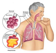 We did not find results for: Patient Education Pneumonia In Adults Beyond The Basics Uptodate
