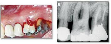 Image result for Periodontal Abscess