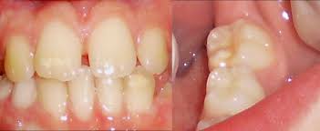 For some reason, mih's neon circles don't glow in some occasions, presumably glitches. Pacientes Con Mih Leve Opacidades Color Blanco Crema Sin Caries Download Scientific Diagram