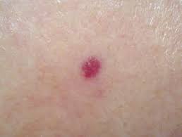 Cherry angioma is a type of tumor or cyst that attacks people above 40 and is marked by the presence of lesions or red color. Cherry Angioma Images Dermnet Nz