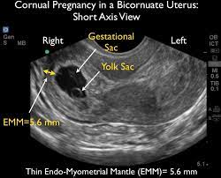 Pregnancy counseling abortion alternatives physicians & surgeons, reproductive endocrinology. Ultrasound Leadership Academy Ultrasound In Early Pregnancy Em Curious