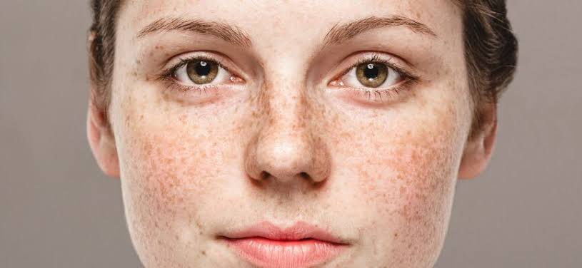Melasma - Varna Pigmentation