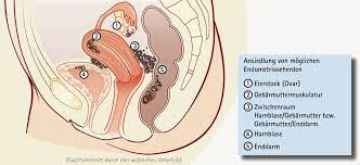 Adenomyosis des uterus ist eine erkrankung, bei der die zellen der uterusschleimhaut auf der symptome und zeichen der uterinen adenomyose: Ivf Saar Emt Adenomyosis Uteri Interna