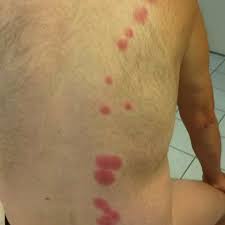 Elles sont généralement de petite taille et plates. Piqures De Punaises De Lit Papules Oedemateuses Groupees De Fac On Download Scientific Diagram