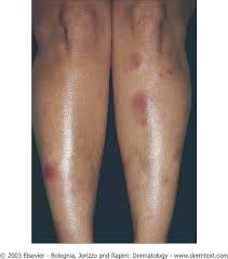 Image result for erythema nodosum