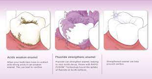 Helps strengthen teeth and fights cavities. Fluoride And Decay Prevention The Smile Makers