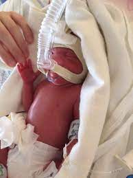 Jamie 25 6 Neonatologie Universitatsklinikum Bonn Facebook
