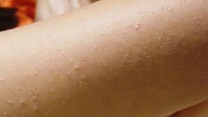 Harde talgklumper er det noen som kaller dette, enkelte kaller det til og med små fettklumper. Nupper I Huden Keratosis Pilaris