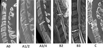 Image result for Subaxial Injury Classification Scale